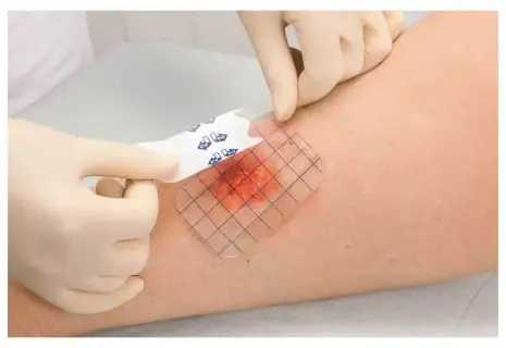 Химики СПбГУ придумали новый гидрогель для заживления ран